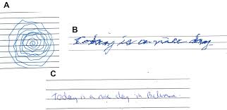 Does This Patient Have Parkinson Disease Or Essential Tremor Clinics In Geriatric Medicine