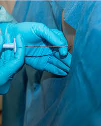 Common guidelines recommend that if more than 4 epidural steroid injections are needed in 1 year, the underlying condition must be managed by other treatment methods. How Long Do Epidural Injections Last For Back Pain