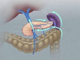 Technique of Laparoscopic Distal Pancreatectomy with Splenectomy
