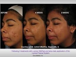 Contact your physician before deciding on any treatment. Anne Marie Struggled For Years With Skin Tone Issues Every Time She Had Even A Minor Acne Breakout New Spots W Hyperpigmentation Acne Cure Uneven Skin Tone