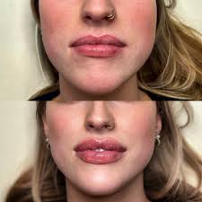 Lip Shaping Session 💋💉 grab your...