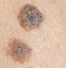 Baseline images of your skin and moles taken. Seborrheic Keratosis Vs Melanoma What S The Difference