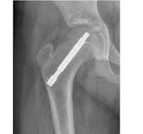 Sistema de tornillos Free-Gliding SCFE™ - OrthoPediatrics
