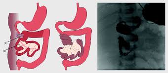 Image result for Intestinal Malrotation
