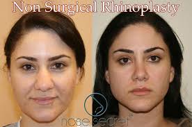 Non Surgical Nose Job For Wide Nose Nosesecret Comprises Of A Couple Of Bended And Agreeable Props That You P Rhinoplasty Nose Jobs Nose Job Nose Contouring