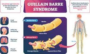 Typically, both sides of the body are involved, and the initial symptoms are changes in sensation or pain often in the back along with muscle weakness. Rare Neurological Disorder Guillain Barre Syndrome Linked To Covid 19