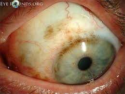 Image result for lesion sclera