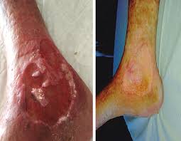 Heridas y Cicatrización