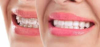 How long will it take to straighten my teeth with invisalign? for more complex cases such as crowded teeth, the treatment time could be 24 months or slightly longer. Can An Orthodontist Straighten Just One Or Two Teeth Academy Dental Cosmetic Dentists