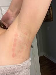 Skin Care Tips After Laser Treatment - Perfection Cosmetic