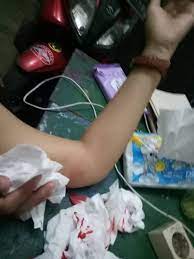 Mar 23, 2020 · misalnya, jika penderita tidak mencuci tangan setelah buang air besar kemudian menyentuh benda yang ada disekitarnya. Curhat Mama Muda Dua Jam Darah Ngucur Dari Lengan Usai Kb Implan Dilepas