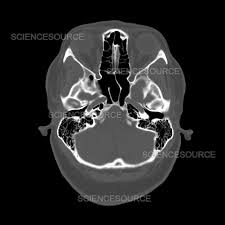 Image result for CT Head