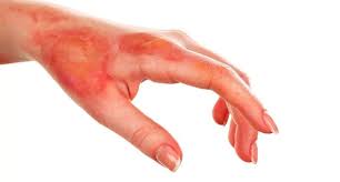 Queimaduras de diversos tipos.