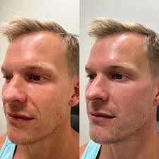 Isaac Waalen, PA-C 💉 (@injectedbyisaac) • Instagram photos and videos