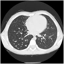 Image result for Broncholithiasis