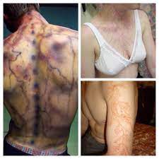 Every 1 in 12,000 people is likely to get struck by lightning and out of the 500 people who do, 90% survive. Lightning Strike Victims Are Sometimes Left With Tattoo Like Markings Or Scars Known As A Lichtenberg
