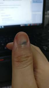 Maybe you would like to learn more about one of these? Jari Tersepit Pintu Bagaimana Menghilangkan Kesakitan Hearty Love Healthy