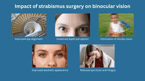 Image result for Strabismus