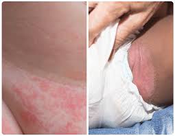 Image result for diaper dermatitis