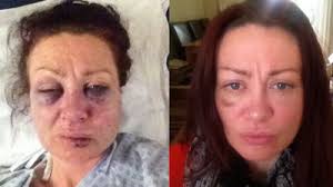 Domestic abuse victim who took selfies of injuries