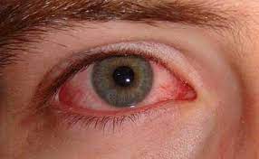 Occorrono 500 grammi di foglie essiccate di betulla (o i kg di. Colpo D Aria All Occhio Sintomi E Rimedi Come Curare