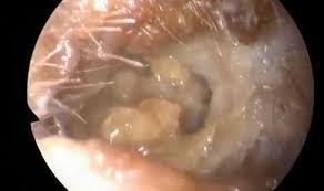 The wax acts as a helpful coating for the ear canal so removal of it is earwax removal see a medical illustration of the ear plus our entire medical gallery of human anatomy and physiology see images. Graphic Content Huge Build Up Of Wax Removed From Patient S Ear Express Co Uk