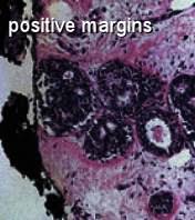 During or after surgery, a pathologist examines this rim of tissue — called the surgical margin or margin of resection — to be sure it's clear of any cancer cells. How To Treat Recurrent Dcis After A Lumpectomy Moose Doc