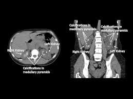 What Is Medullary Sponge Kidney