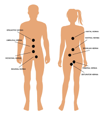 There are three types of ventral hernia: Specialist Hernia Surgeon Sydney Prof Chris Berney