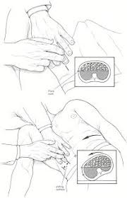 Image result for Shifting Dullness Test