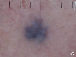 Image result for Blue Nevus