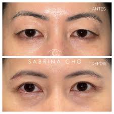 ELEGÂNCIA E NATURALIDADE. Resultado que respeita a característica oriental  e traz um olhar mais jovial. Essa paciente querida me falou. “Dra, sabe o  que é mais legal da sua cirurgia? Ninguém sabe