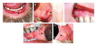 Image result for Aphthasol