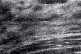 La mastite est un terme général pour l'inflammation du sein. Pathologie Mammaire De L Enfant Et De L Adolescente Gynecologie Obstetrique Pratique