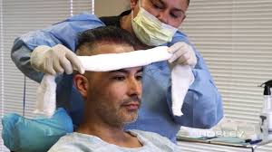 Bosley hair zu günstigen preisen. Bosley Fue Procedure Edgar S Journey Hair Transplant How It S Done Youtube