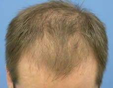 Diffuse patterned alopecia (dpa) is a type of hair loss that does not progress to the point of complete baldness in any given area of the scalp, but rather introduces a general overall thinning of the hairs. Diffuse Patterned Alopecia Causes And Treatments Diffuse Hair Loss Hair Loss Medication Alopecia