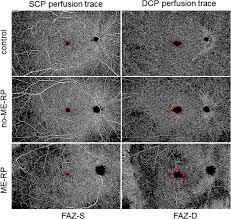 The findings will assist octa in its mission to develop an integrated and balanced transportation system that supports the diverse. The Impact Of Macular Edema On Microvascular And Metabolic Alterations In Retinitis Pigmentosa Springerlink