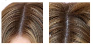 It's also likely that inflammation in the hair follicles leads to fibrosis, which causes hair follicle miniaturization. Pin On Beauty Grooming