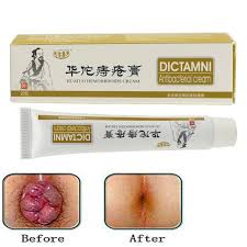 Check spelling or type a new query. Hemorrhoids Ointment Plant Herbal Hemorrhoids Cream Internal Hemorrhoids Piles External Anal Fissure China Medicine Huatuo Cream Sets Aliexpress