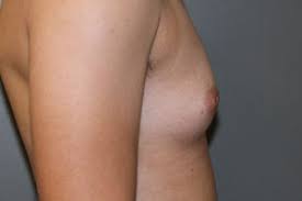 Ftm Top Surgery Scottsdale Phoenix Az We have found that our ftm breast surgery patients are at the top among our happiest, most satisfied and according to data shared on realself, the cost of ftm top surgery is generally between $4,900 and $12,000 in the scottsdale area, with the average. ftm top surgery scottsdale phoenix az