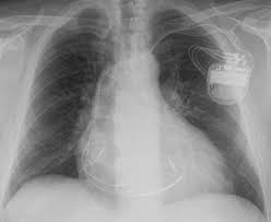 Pek çok doku ve kemiklerin görüntülenmesinde yaygın olarak kullanılır ve ağrısız bir tetkiktir. Kardiologie Herzschrittmacher Defibrillatoren Kardiale Resynchronisations Therapie