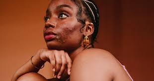 I have often been asked of how to lighten ethnic skins. What Is Body Hyperpigmentation Causes Treatment