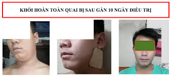 Bs Tuy điều trị quai bị bằng Cao dán gia truyền- Không dùng kháng sinh