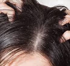 Try these 31 dry scalp home remedies that really work. 9 Steps To Treat Dry Scalp Dermatology Center Of The Rockies