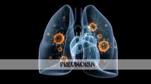 Pneumonia is a bacterial, viral, or fungal infection of the lungs that causes the air sacs, or alveoli, of the lungs to fill up with fluid or pus. Radiologia Pneumonia No Raio X Youtube