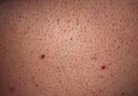 Image result for Keratosis pilaris