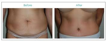 Before After Plastic Surgery Photos Beautiful Patient Results Tummy Tuck Results Plastic Surgery Photos Tummy Tucks
