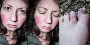 Long COVID sidelines thousands of Wisconsin workers