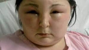 Britânica desenvolve alergia a tintura de cabelo e fica com o rosto tão  inchado que não consegue enxergar