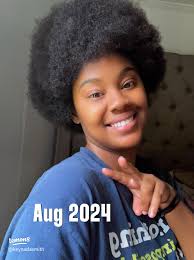 Effective Products for Alopecia Treatment: My Journey Part 1